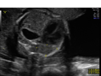 Congenital diaphragmatic hernia chest_view